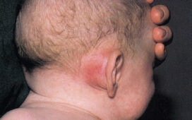 Exposing the aqBone Beneath the Ear The Mastoid Procedure
