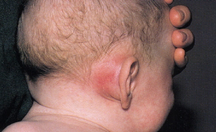 Exposing the aqBone Beneath the Ear The Mastoid Procedure