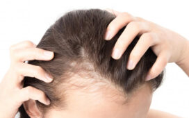 When Hair Loss Should Be Considered A Condition
