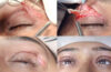 Enhancing Confidence The Role of Specialised Double Eyelid Clinics